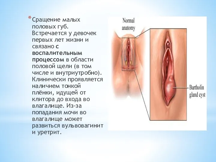 Сращение малых половых губ. Встречается у девочек первых лет жизни