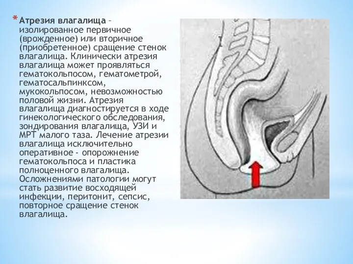 Атрезия влагалища – изолированное первичное (врожденное) или вторичное (приобретенное) сращение