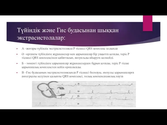 Түйіндік және Гис будасынан шыққан экстрасистолалар: А –жоғары түйіндік экстрасистолияда