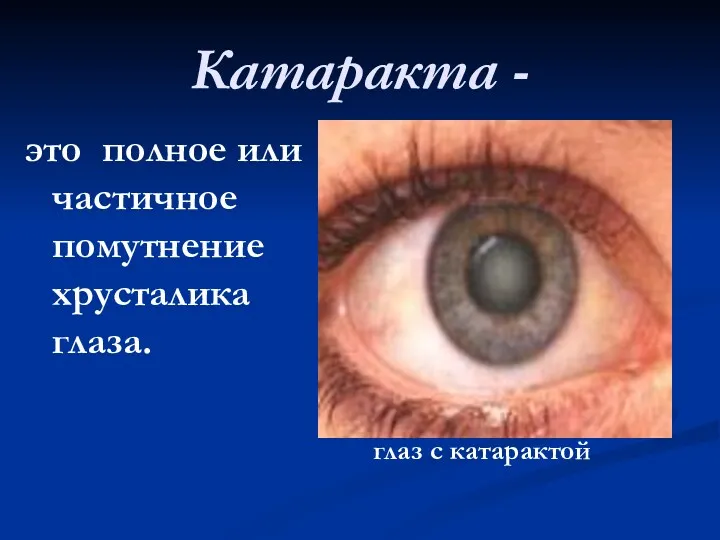 Катаракта - это полное или частичное помутнение хрусталика глаза. глаз с катарактой глаз с катарактой