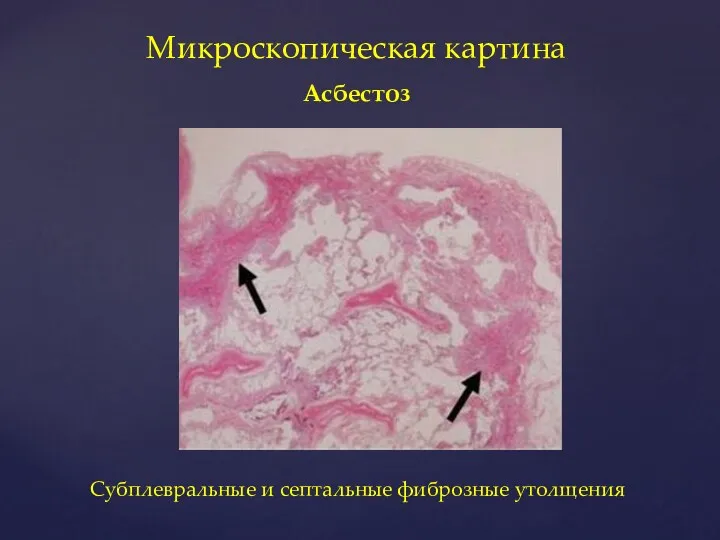 Микроскопическая картина Асбестоз Субплевральные и септальные фиброзные утолщения