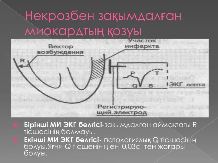 Некрозбен зақымдалған миокардтың қозуы Бірінші МИ ЭКГ белгісі-зақымдалған аймақтағы R тісшесінің болмауы. Екінші