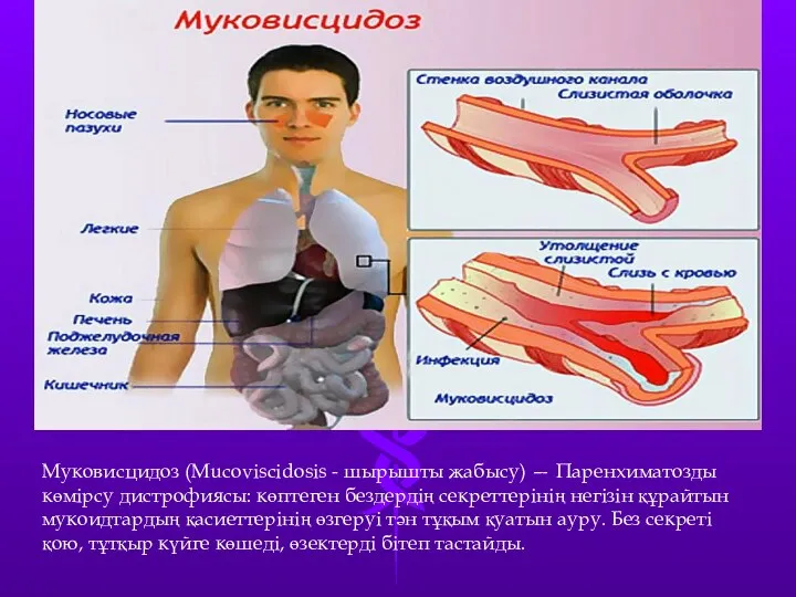 Муковисцидоз (Мuсоviscidosis - шырышты жабысу) — Паренхиматозды көмірсу дистрофиясы: көптеген