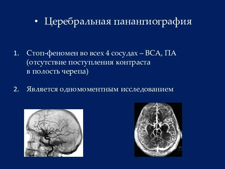 Церебральная панангиография Стоп-феномен во всех 4 сосудах – ВСА, ПА (отсутствие поступления контраста