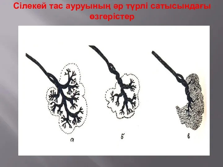 Сілекей тас ауруының әр түрлі сатысындағы өзгерістер