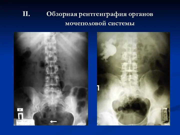 Обзорная рентгенграфия органов мочеполовой системы