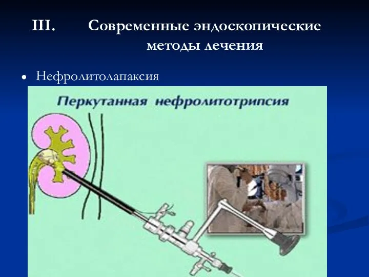 Современные эндоскопические методы лечения Нефролитолапаксия