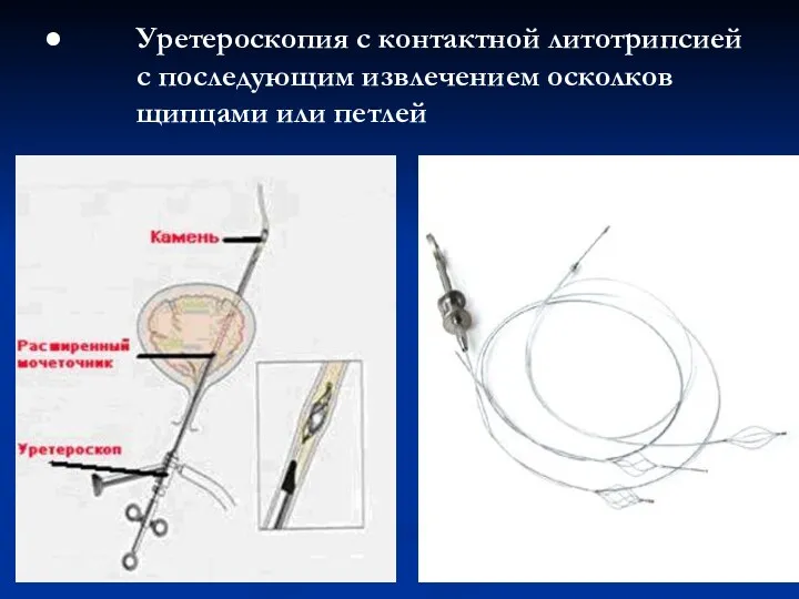 Уретероскопия с контактной литотрипсией с последующим извлечением осколков щипцами или петлей