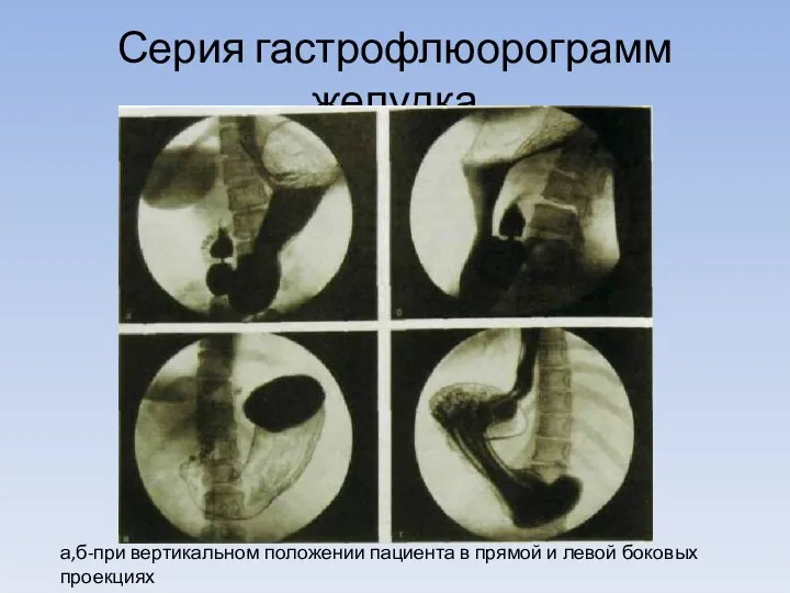 Серия гастрофлюорограмм желудка а,б-при вертикальном положении пациента в прямой и