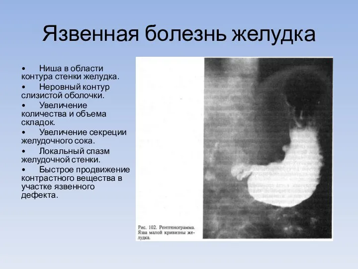 Язвенная болезнь желудка • Ниша в области контура стенки желудка.