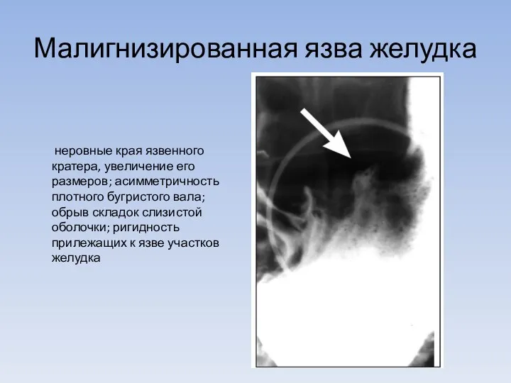 Малигнизированная язва желудка неровные края язвенного кратера, увеличение его размеров;