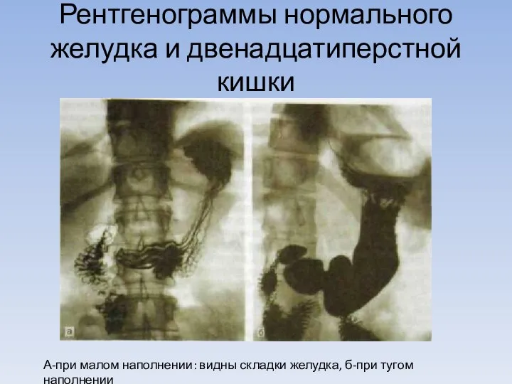 Рентгенограммы нормального желудка и двенадцатиперстной кишки А-при малом наполнении: видны складки желудка, б-при тугом наполнении