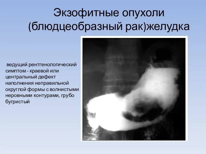 Экзофитные опухоли(блюдцеобразный рак)желудка ведущий рентгенологический симптом - краевой или центральный