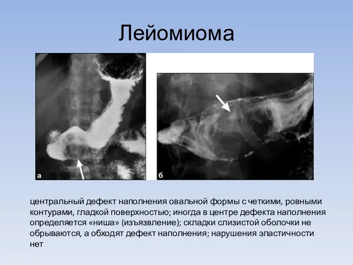 Лейомиома центральный дефект наполнения овальной формы с четкими, ровными контурами,