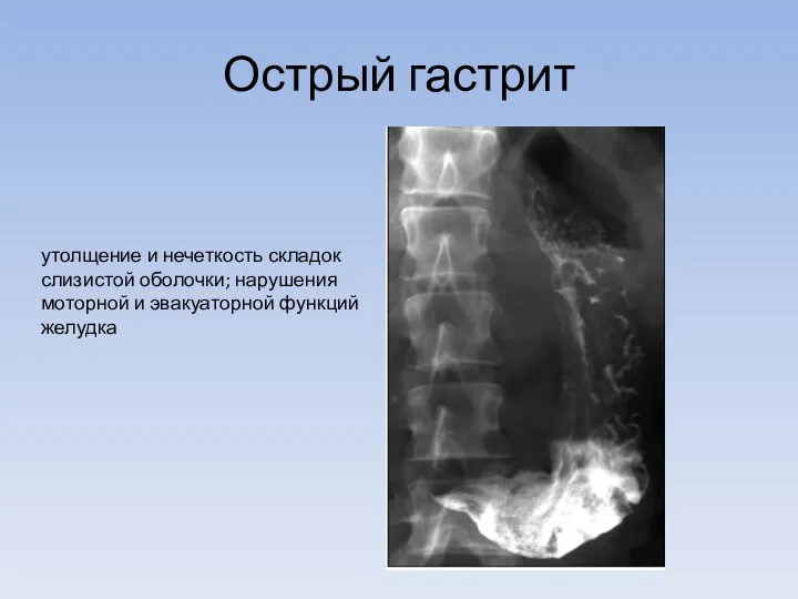 Острый гастрит утолщение и нечеткость складок слизистой оболочки; нарушения моторной и эвакуаторной функций желудка