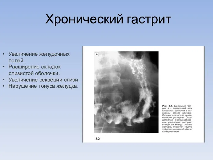 Хронический гастрит Увеличение желудочных полей. Расширение складок слизистой оболочки. Увеличение секреции слизи. Нарушение тонуса желудка.