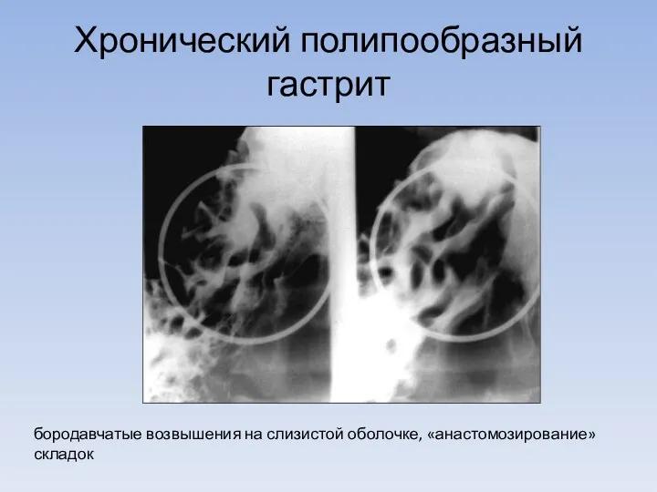 Хронический полипообразный гастрит бородавчатые возвышения на слизистой оболочке, «анастомозирование» складок