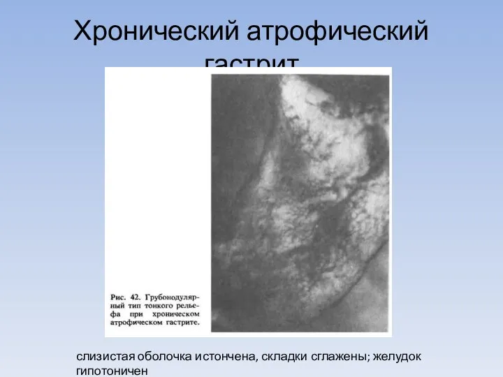 Хронический атрофический гастрит слизистая оболочка истончена, складки сглажены; желудок гипотоничен