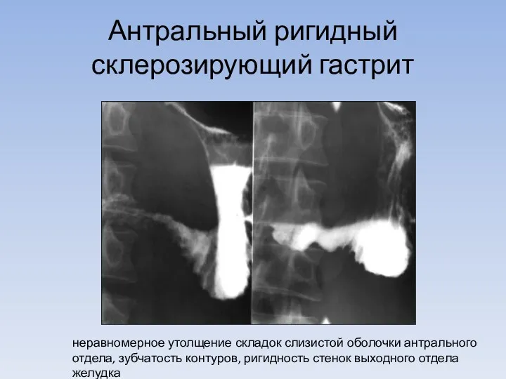 Антральный ригидный склерозирующий гастрит неравномерное утолщение складок слизистой оболочки антрального