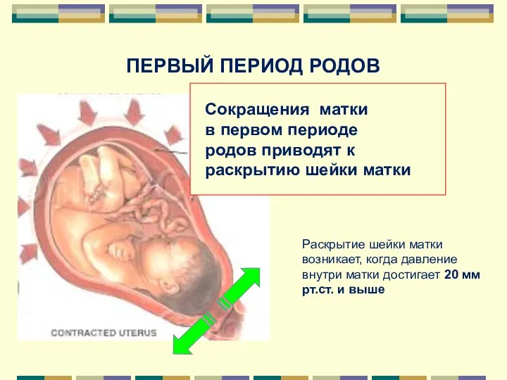 ПЕРВЫЙ ПЕРИОД РОДОВ Сокращения матки в первом периоде родов приводят