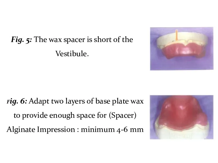 Fig. 5: The wax spacer is short of the Vestibule. Fig. 6: Adapt
