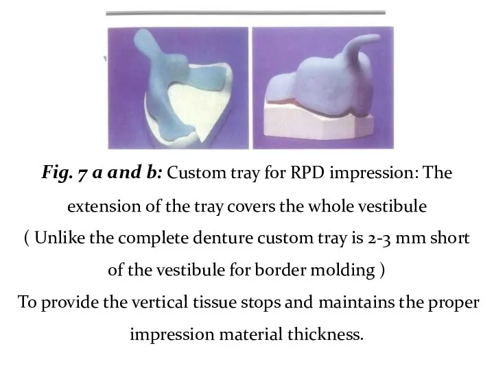 Fig. 7 a and b: Custom tray for RPD impression: The extension of