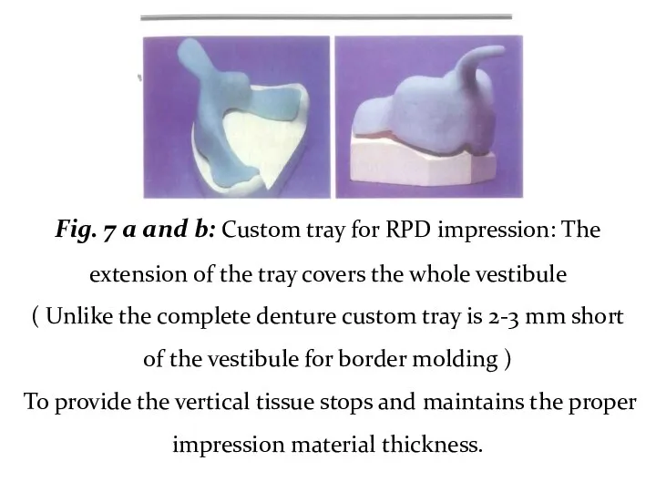 Fig. 7 a and b: Custom tray for RPD impression: