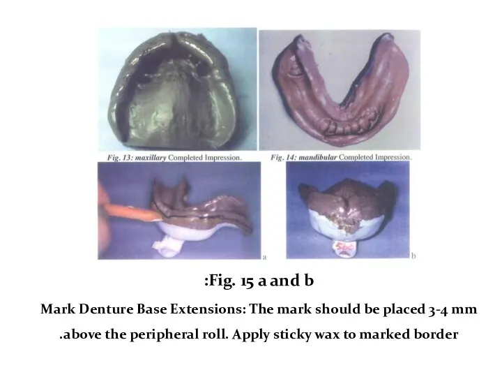 Fig. 15 a and b: Mark Denture Base Extensions: The mark should be