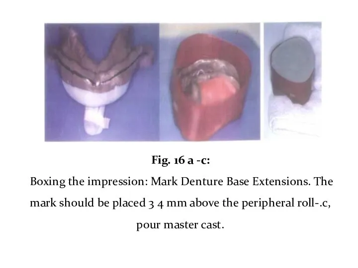 Fig. 16 a -c: Boxing the impression: Mark Denture Base Extensions. The mark