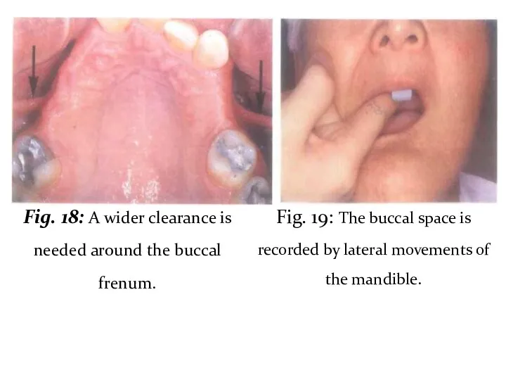 Fig. 18: A wider clearance is needed around the buccal frenum. Fig. 19: