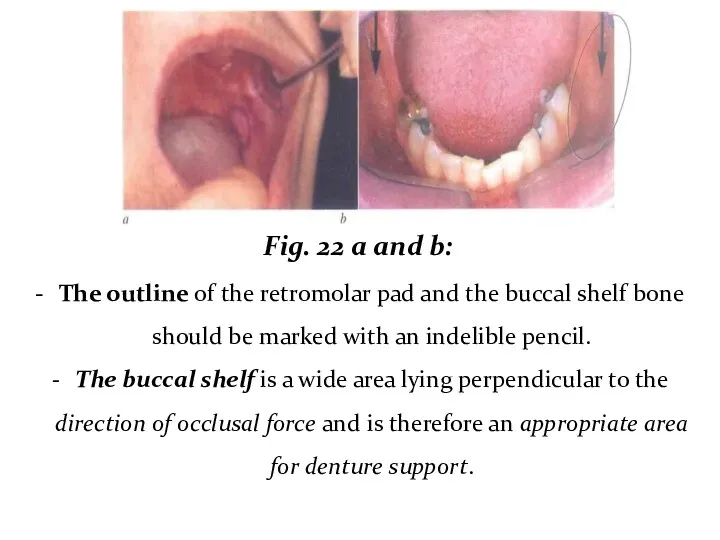 Fig. 22 a and b: The outline of the retromolar pad and the