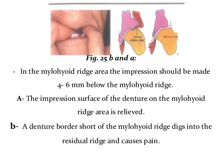 Fig. 25 b and a: In the mylohyoid ridge area the impression should