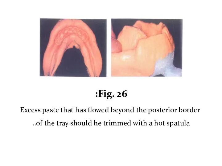 Fig. 26: Excess paste that has flowed beyond the posterior border of the
