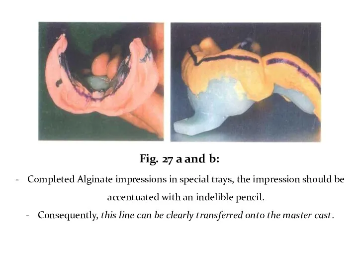 Fig. 27 a and b: Completed Alginate impressions in special trays, the impression