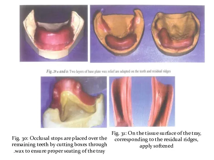 Fig. 30: Occlusal stops are placed over the remaining teeth by cutting boxes