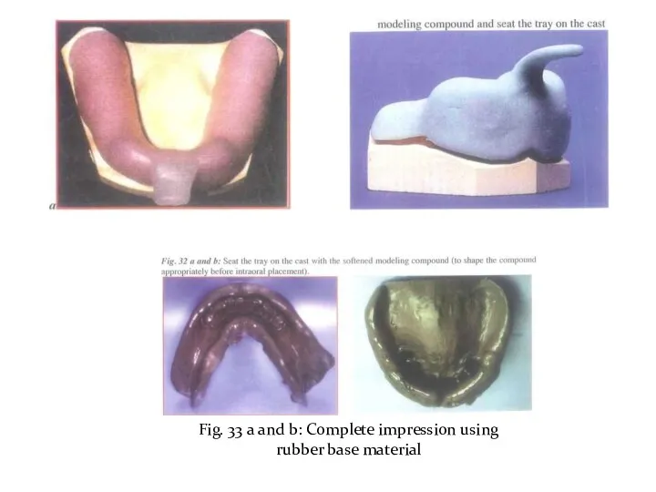 Fig. 33 a and b: Complete impression using rubber base material