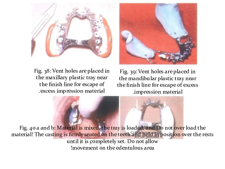 Fig. 38: Vent holes are placed in the maxillary plastic tray near the