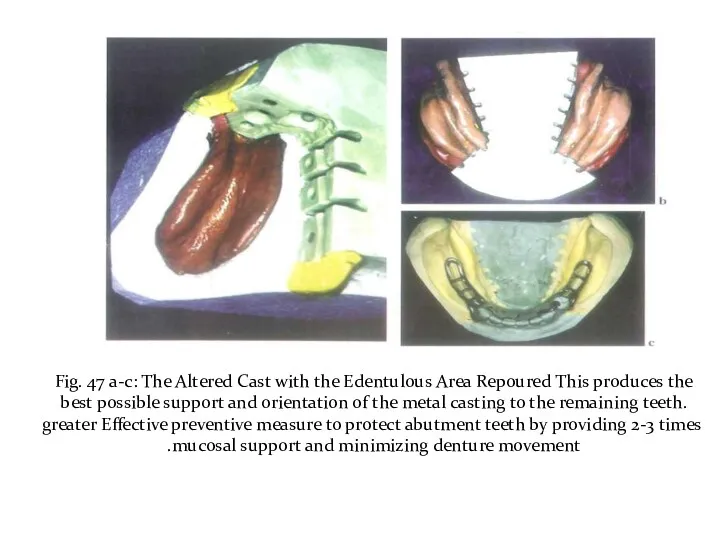 Fig. 47 a-c: The Altered Cast with the Edentulous Area Repoured This produces