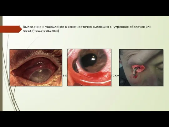 Выпадение и ущемление в ране частично выпавших внутренних оболочек или сред (чаще радужки)
