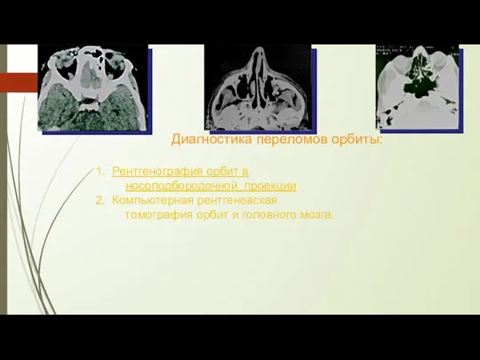 Диагностика переломов орбиты: Рентгенография орбит в носоподбородочной проекции Компьютерная рентгеновская томография орбит и головного мозга.