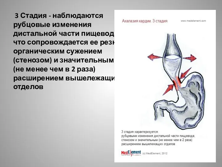 3 Стадия - наблюдаются рубцовые изменения дистальной части пищевода, что