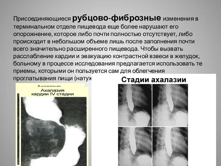 Присоединяющиеся рубцово-фиброзные изменения в терминальном отделе пищевода еще более нарушают