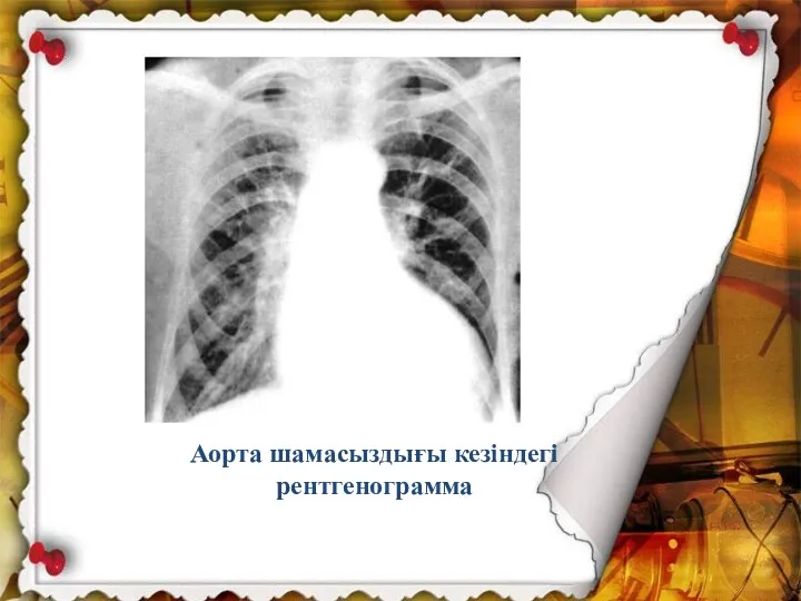 Аорта шамасыздығы кезіндегі рентгенограмма