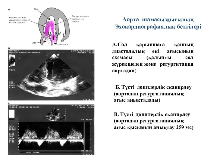 Аорта шамасыздығының Эхокардиографиялық белгілері А.Сол қарыншаға қанның диастолалық екі ағысының