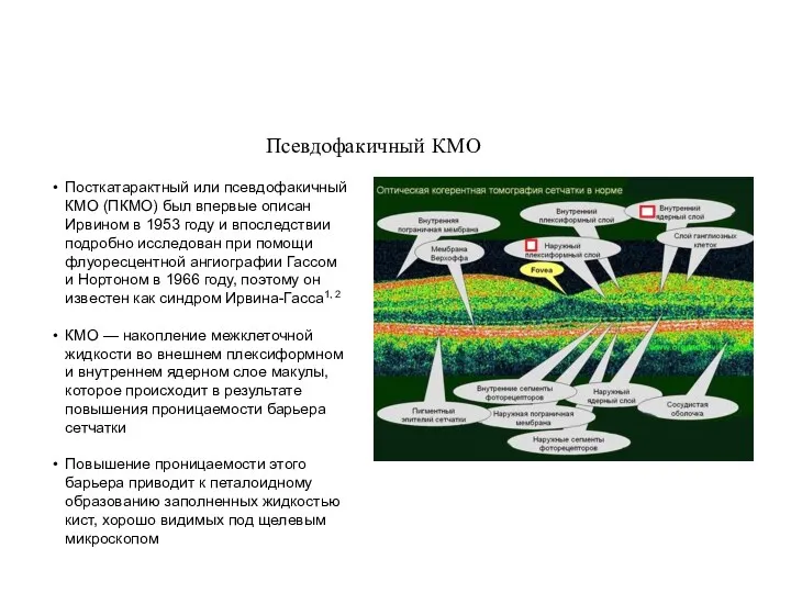 Псевдофакичный КМО Посткатарактный или псевдофакичный КМО (ПКМО) был впервые описан