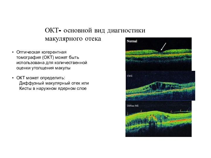 ОКТ- основной вид диагностики макулярного отека Оптическая когерентная томография (ОКТ)