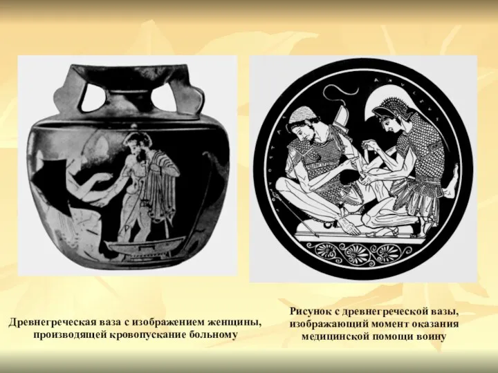 Древнегреческая ваза с изображением женщины, производящей кровопускание больному Рисунок с древнегреческой вазы, изображающий