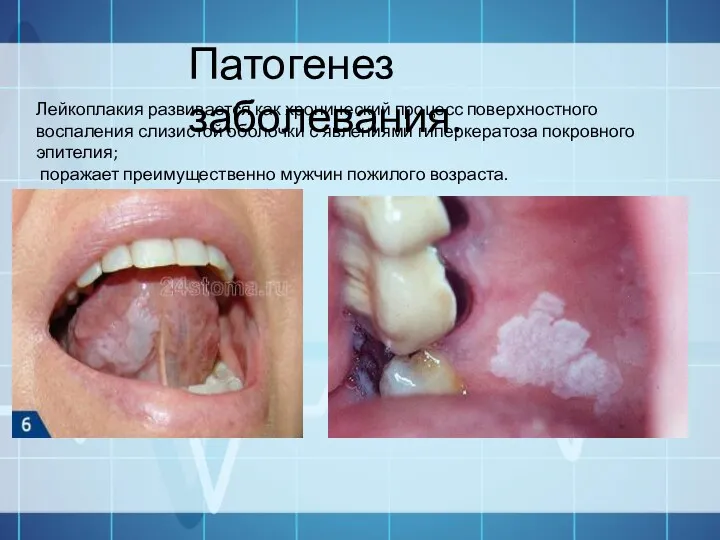 Патогенез заболевания. Лейкоплакия развивается как хронический процесс поверхностного воспаления слизистой