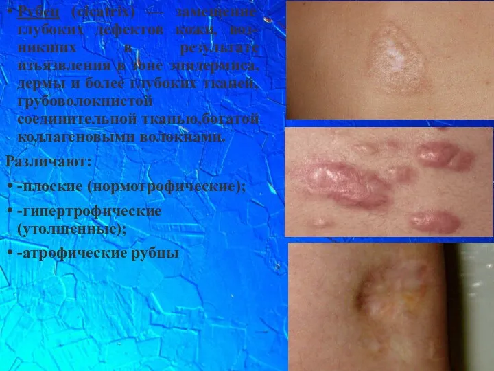 Рубец (cicatrix) — замещение глубоких дефектов кожи, воз-никших в результате изъязвления в зоне