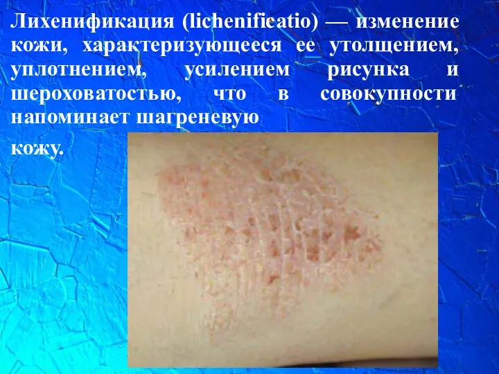Лихенификация (lichenificatio) — изменение кожи, характеризующееся ее утолщением, уплотнением, усилением